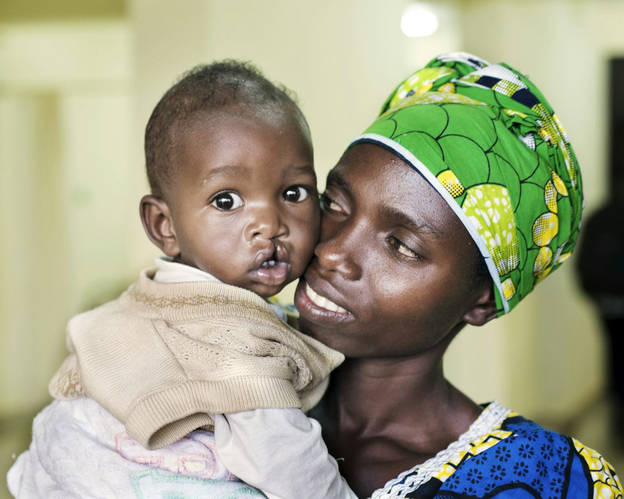 liten pojke med läppspalt i rwanda