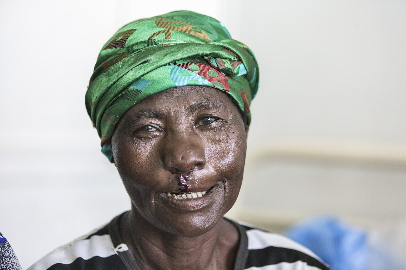 gammal kvinna glad efter operation för läppspalt