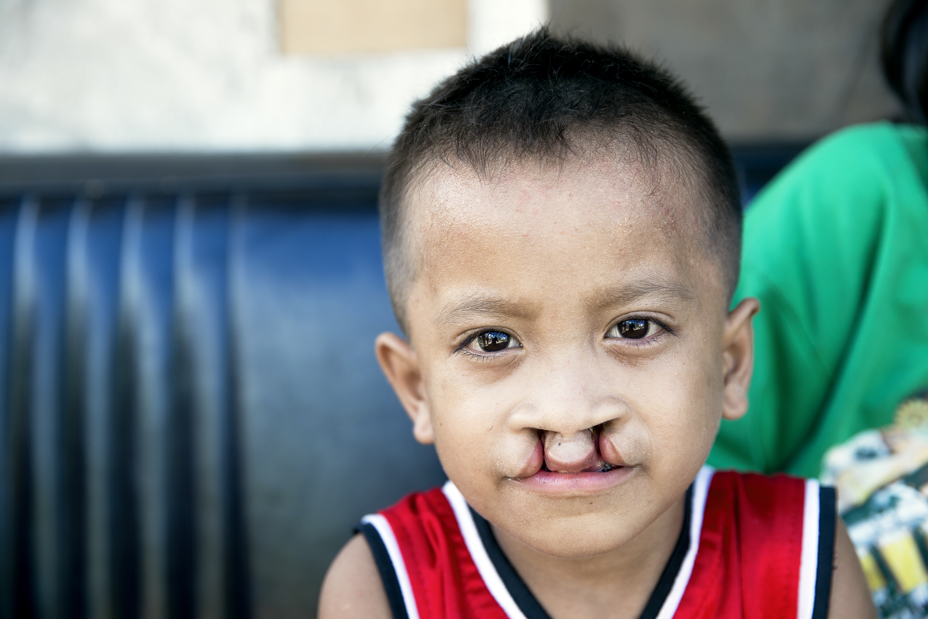 En pojke med dubbelsidig läppspalt tittar in i kameran.