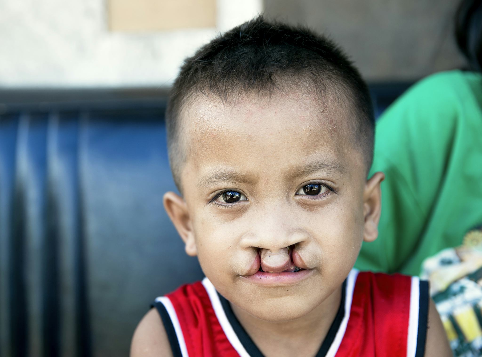 En pojke med dubbelsidig läppspalt tittar in i kameran.