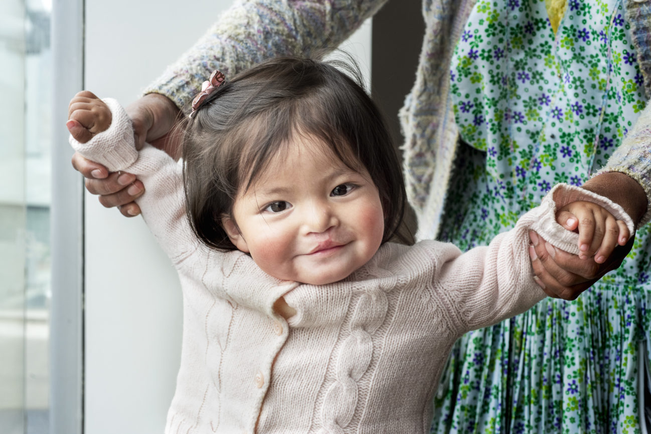 flicka 8 månader gammal strålar av glädje efter sin operation
