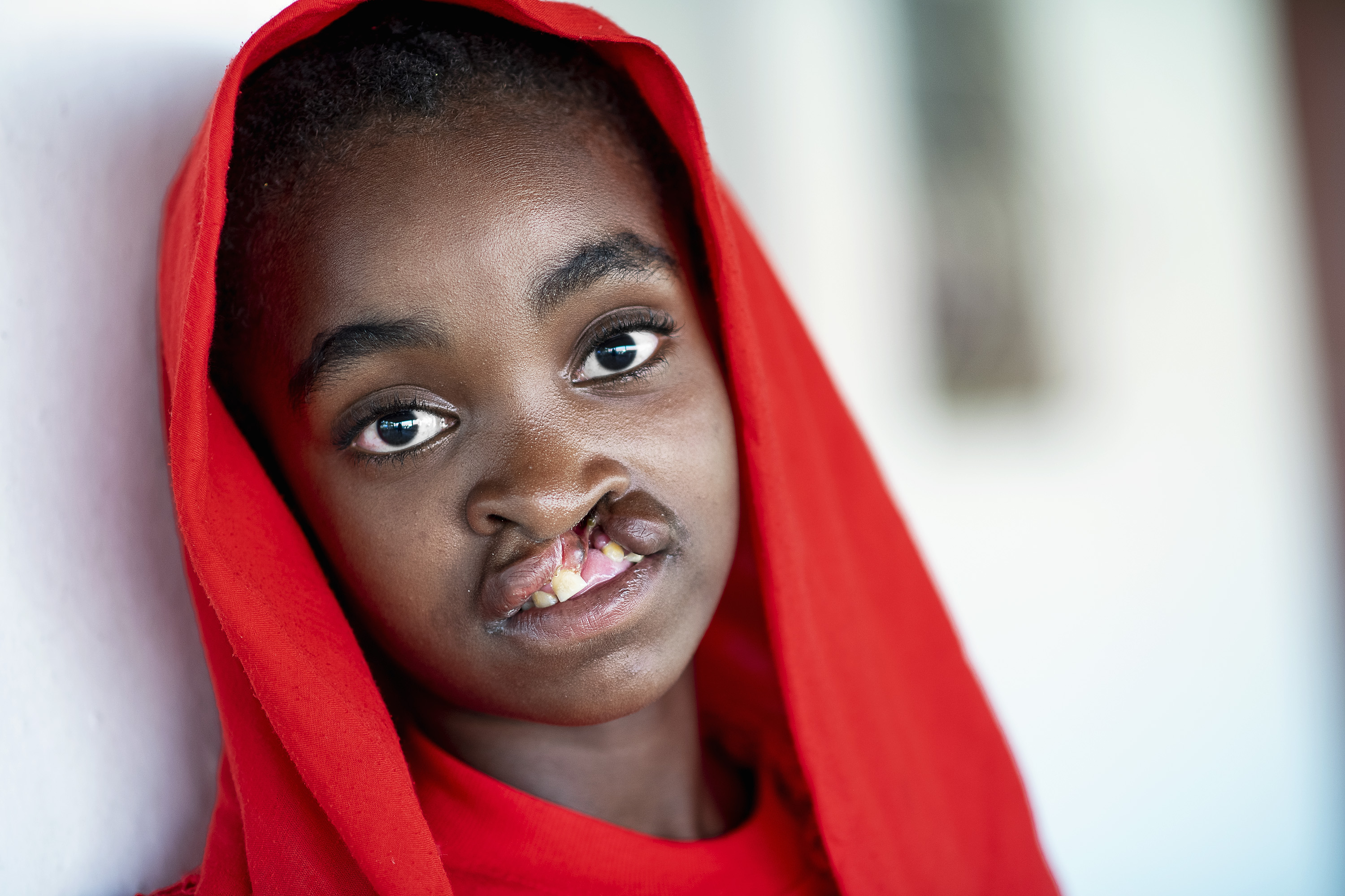 En 10-årig flicka med läpp-käk-gomspalt, klädd i rött. Hon tittar in i kameran.