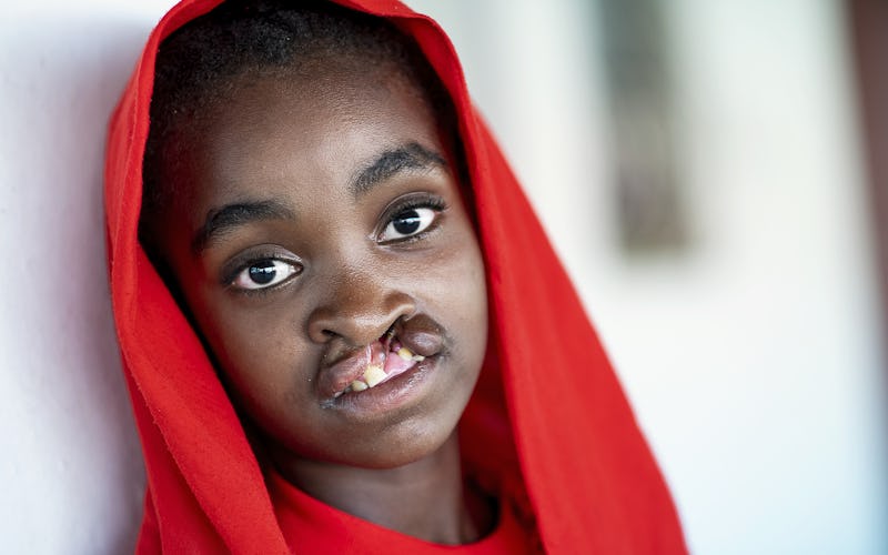 Ett barn med röd huvudscarf tittar mot kameran och har läppspalt samt synliga tandproblem.