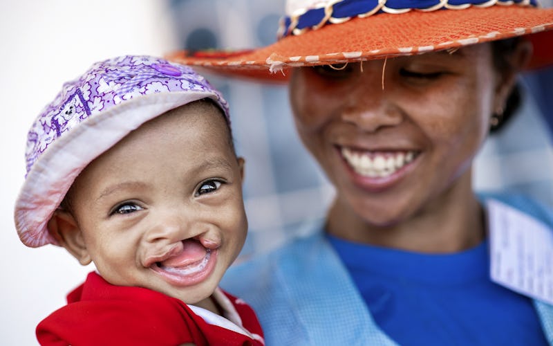 En kvinna håller en bebis med läppspalt, båda har kläder och hattar på sig.