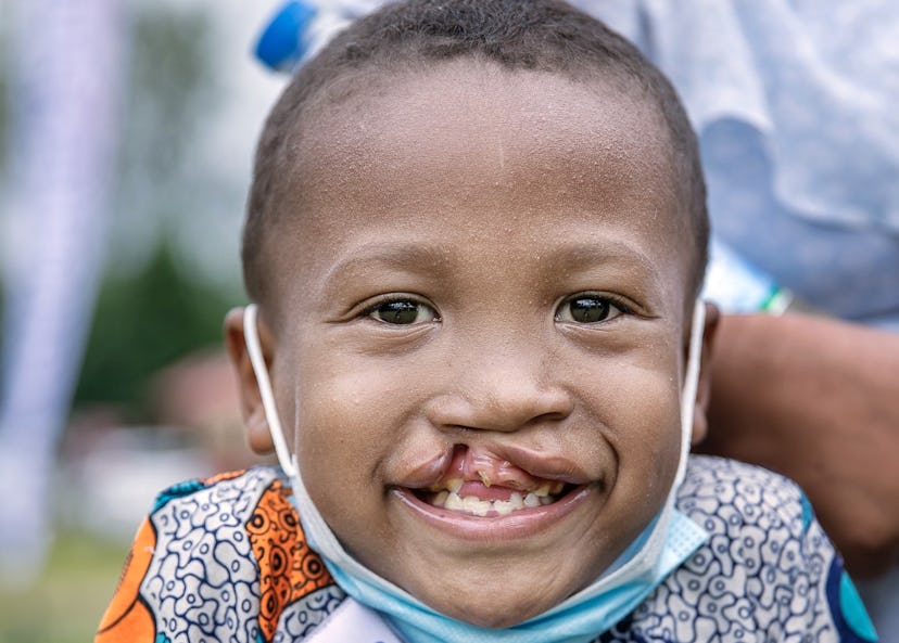 Närbild på sexårige Honoré med läppspalt. Han ler stort och tittar in i kameran med ett munskydd under hakan.