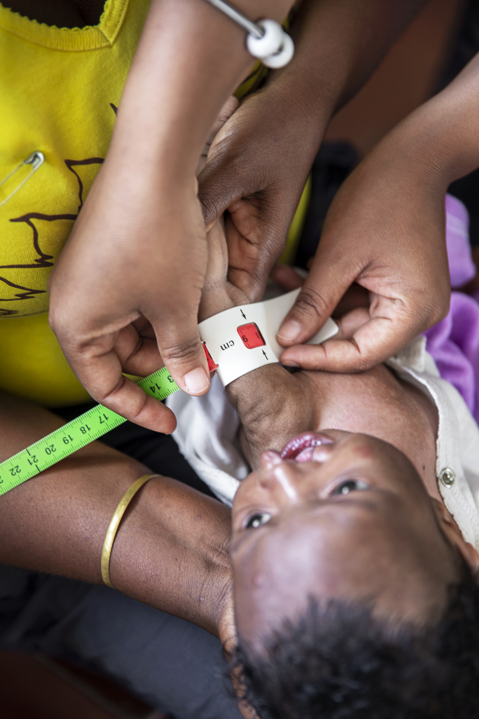 Närbild på Leasy där hans arm mäts och visar att han är svårt undernärd