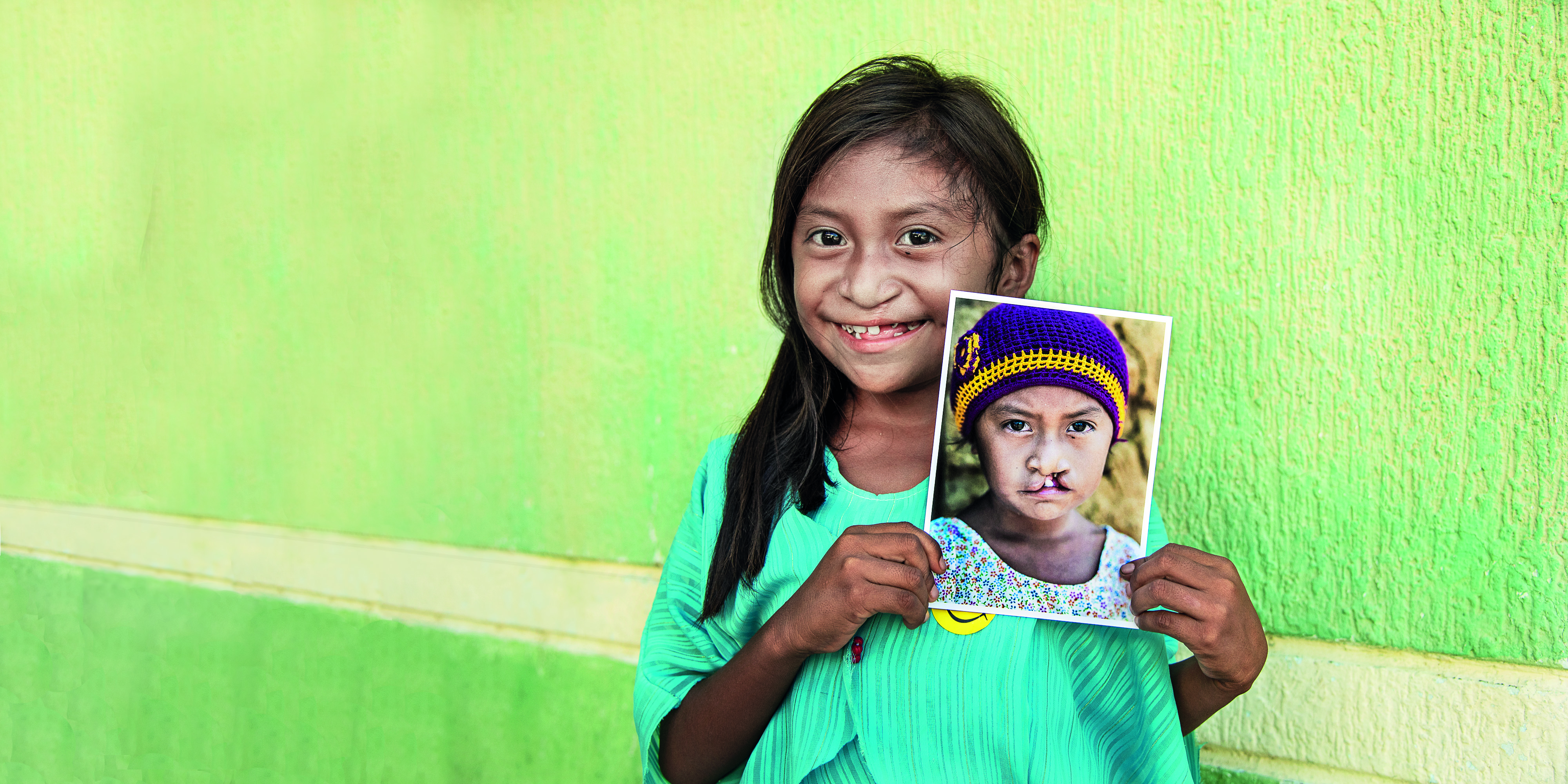 Om Operation Smile Operation Smile Sverige