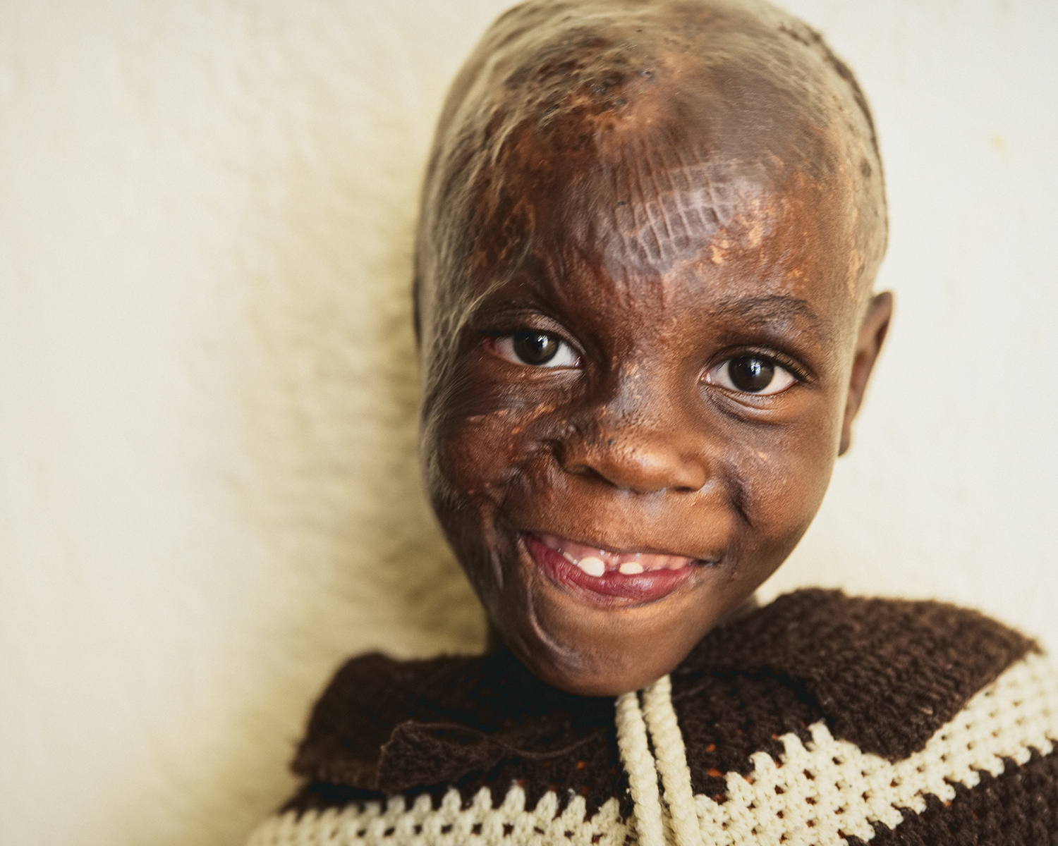 Närbild på en flicka som leende tittar in i kameran. Hon är brännskadad i ansiktet och på huvudet och har inget hår.