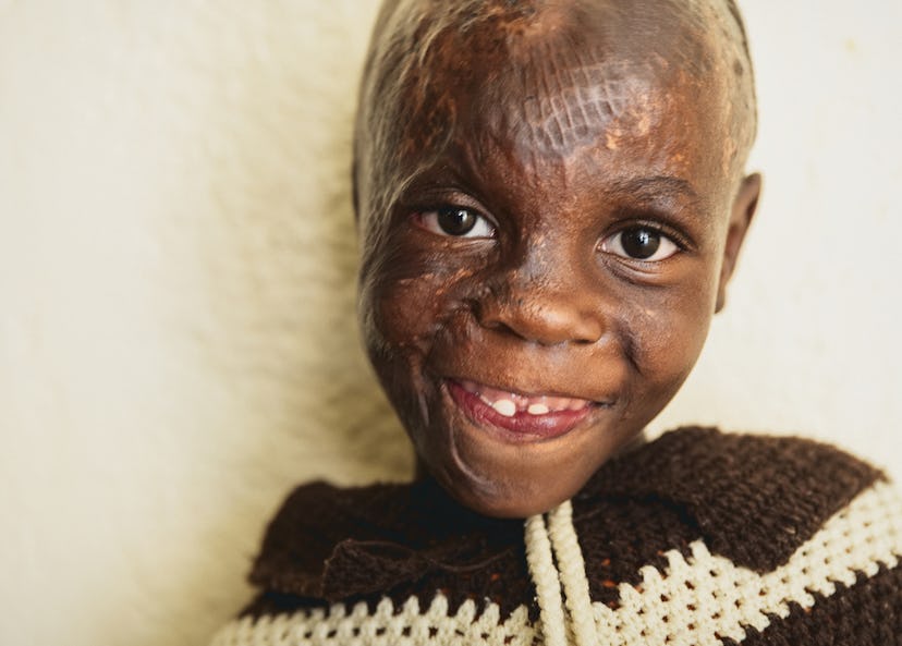 Närbild på en flicka som leende tittar in i kameran. Hon är brännskadad i ansiktet och på huvudet och har inget hår.