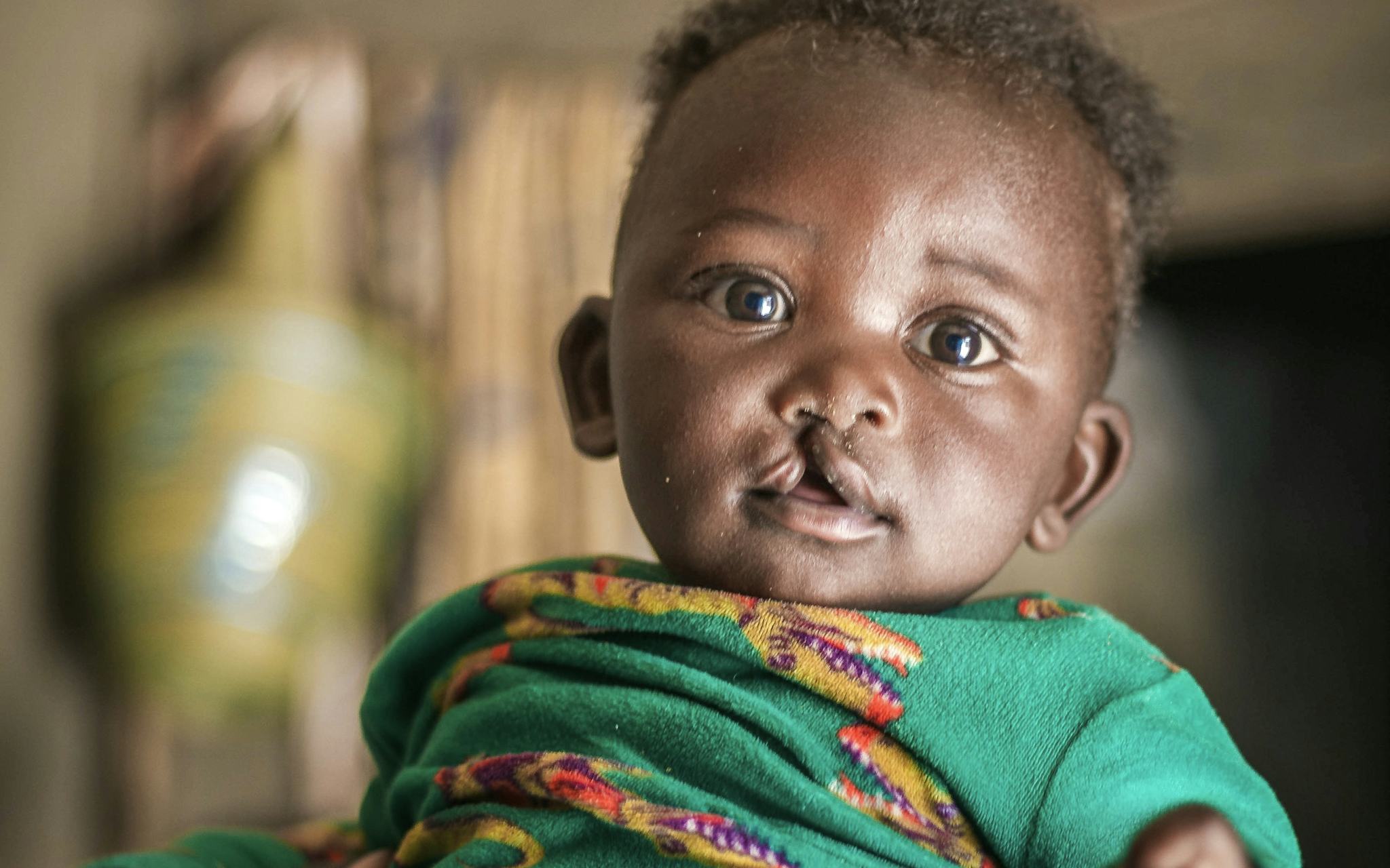 En person håller upp ett barn på ungefär 6 månader. Barnet har läppspalt och ser rakt in i kameran.