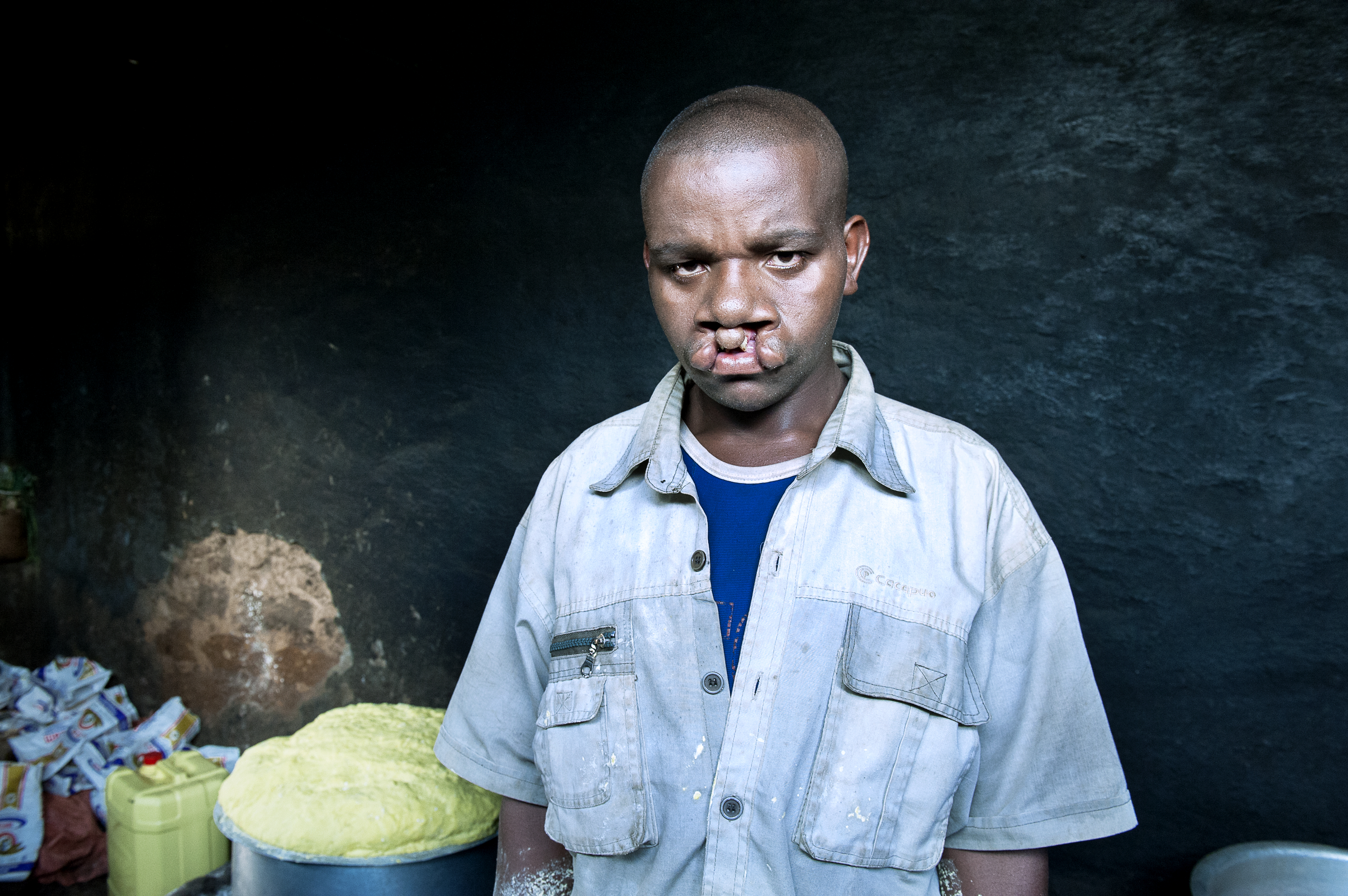 En ung man med läppspalt ser allvarligt in i kameran.