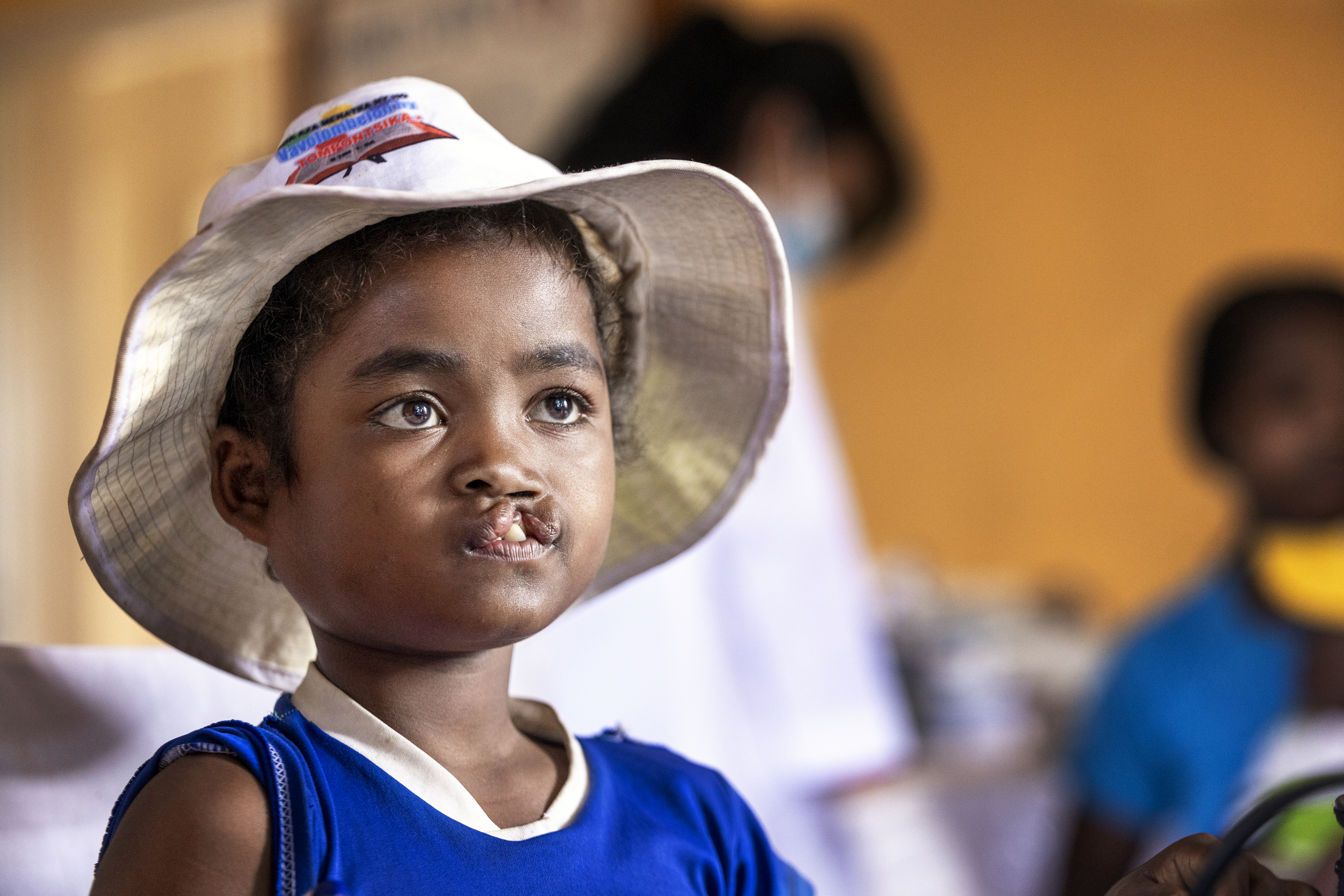 En flicka med läppspalt iklädd stor vit solhatt.