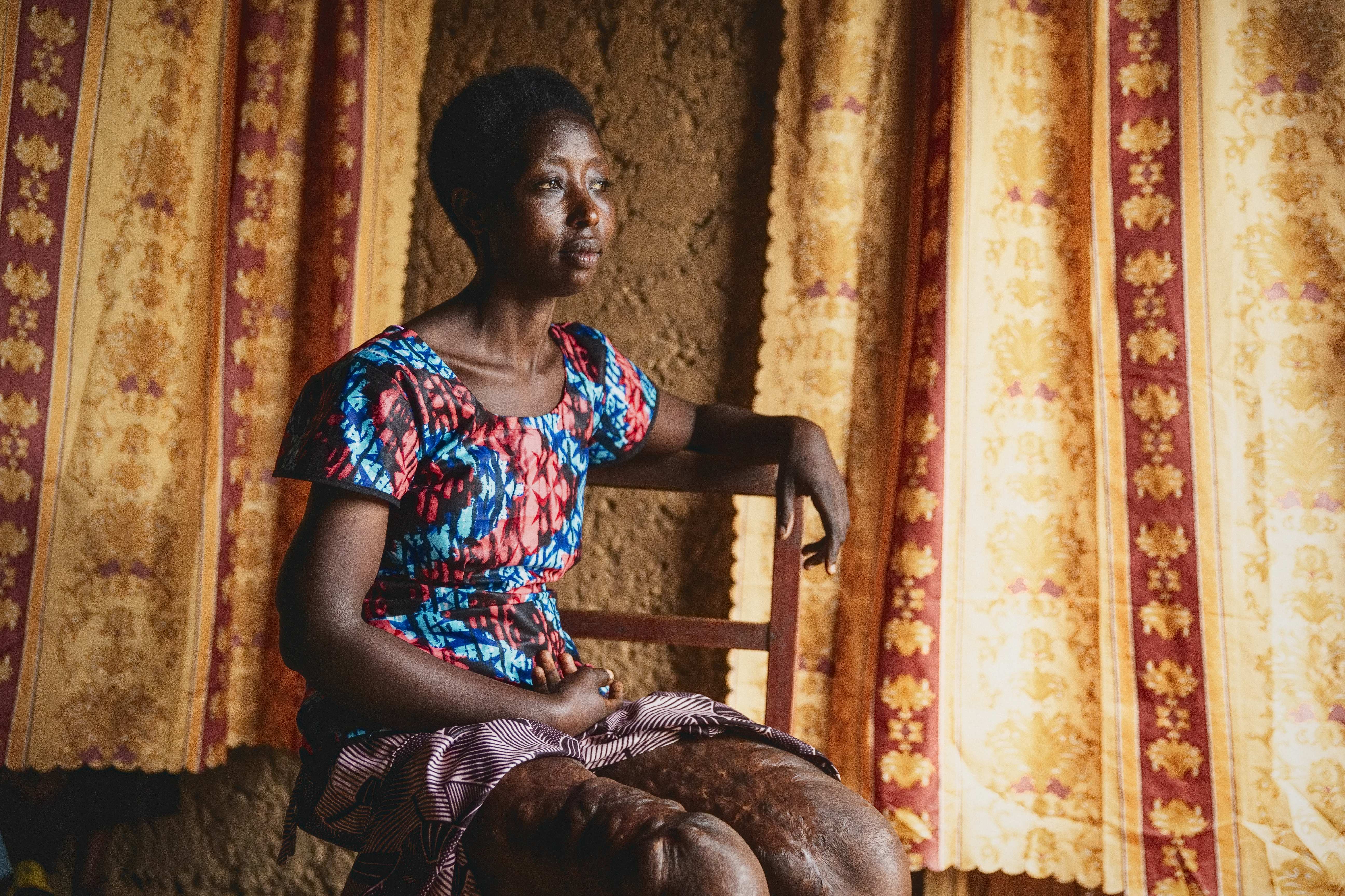 En kvinna sitter på en stol. Hennes bara ben bär ärr av de brännskador hon fick under folkmordet i Rwanda.