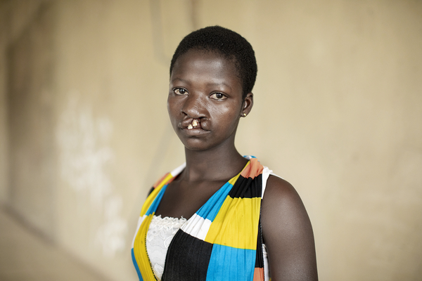 En ung kvinna med kort hår och läppspalt tittar mot kameran, har ärmlös mönstrad klänning och står mot enkel bakgrund.