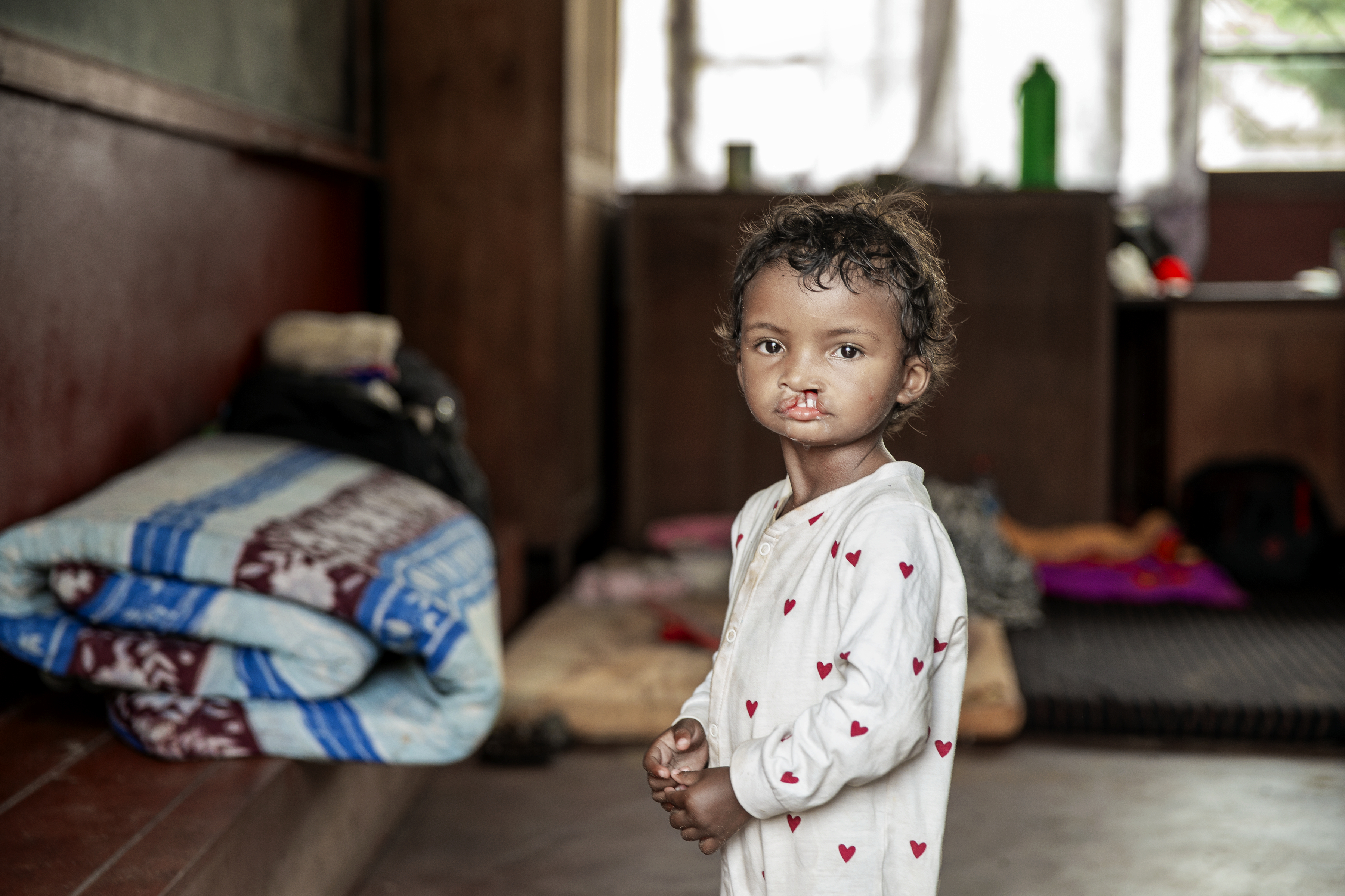 Ett barn med läppspalt står inomhus med en vit tröja med röd hjärtan; filtar och sängkläder syns i bakgrunden.